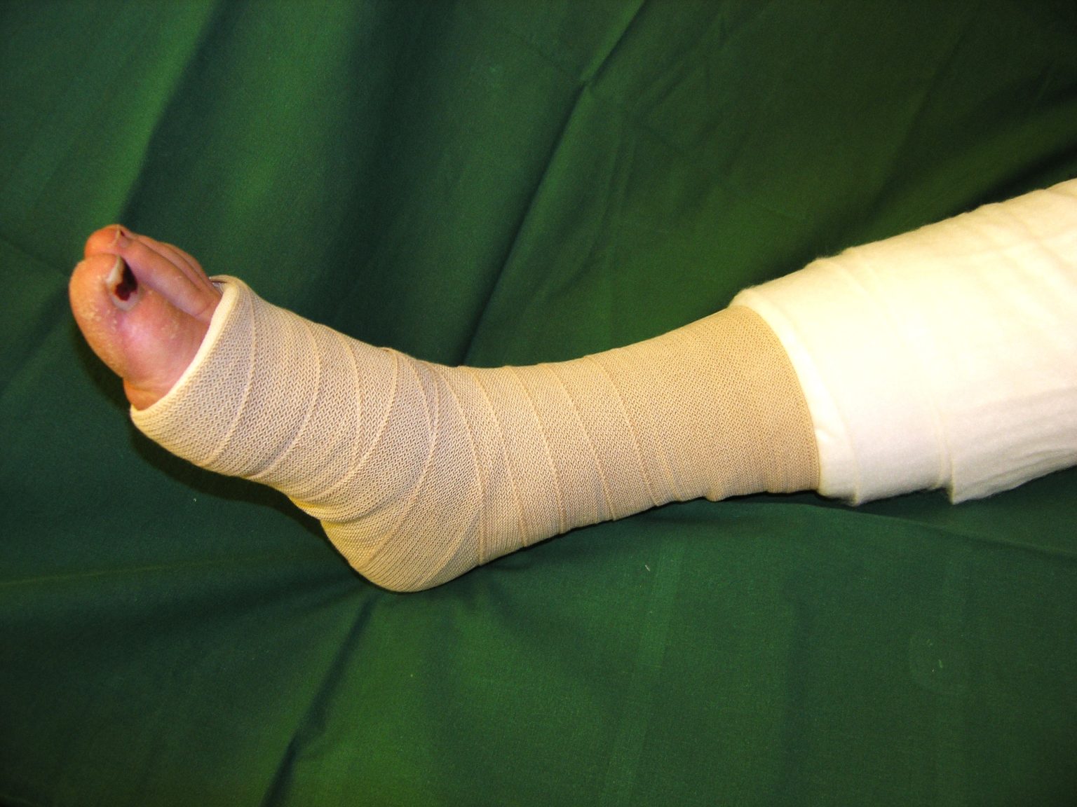 Behandling - kompression - Svensk Förening för Lymfologi